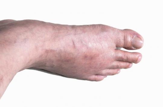 Gout: unbearable crises