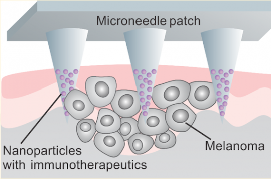 Melanoma: a patch for a more targeted treatment