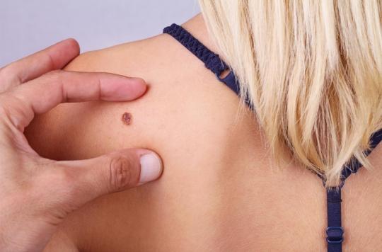 Skin cancer: a new device for diagnosis without sampling