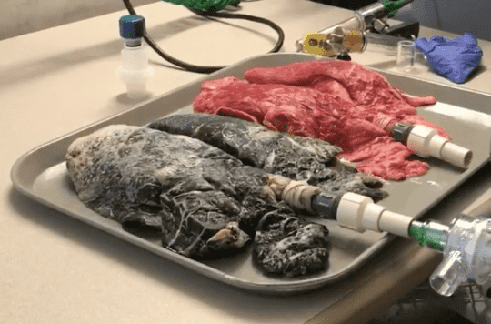 VIDEO.  Nurse shows blackened lungs of patient who smoked a pack of cigarettes a day for 20 years