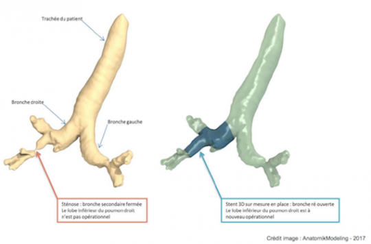 Toulouse University Hospital successfully completes the first tailor-made trachea transplant