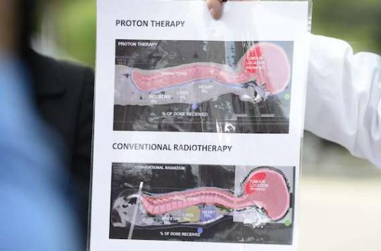 Brain cancer: proton therapy reduces side effects