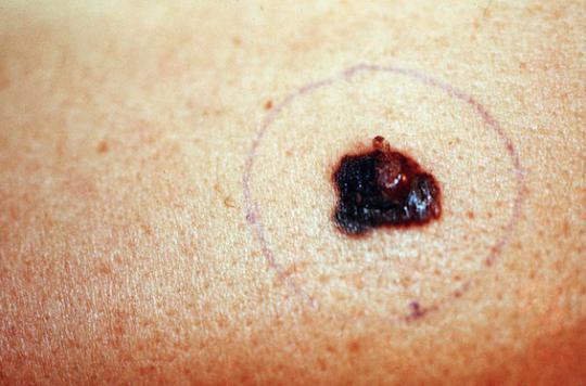 Melanoma: better results with immunotherapies 