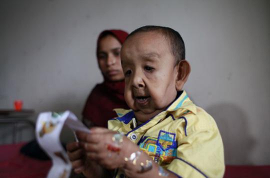 Bangladesh: 4-year-old looks like an old man