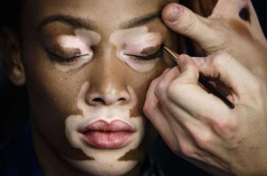 Vitiligo: a revolutionary treatment to make dark spots disappear
