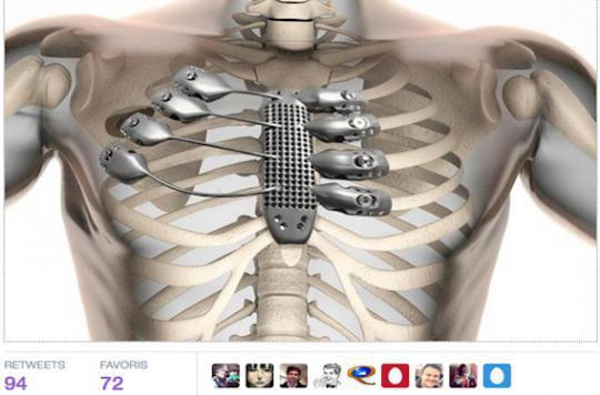 3D printed breastbone saves Spanish patient