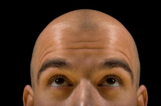 Baldness: immune cells involved