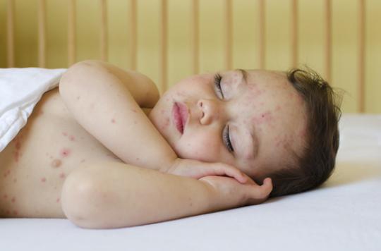 Chickenpox: Pays-de-Loire particularly affected