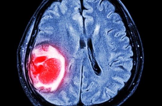 Glioblastoma: hydroxyurea enhances the effectiveness of chemotherapy