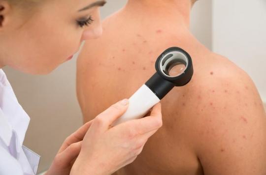 Skin cancers: the signs that should alert