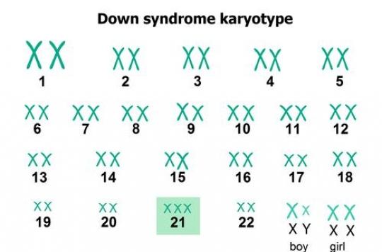 Trisomy 21, an overdose of proteins disrupts the functioning of cells