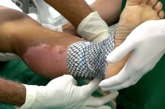 Burns: tilapia skin heals wounds inexpensively