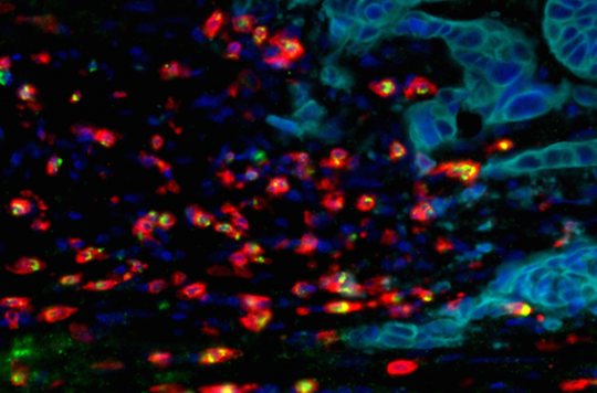 Metastases: the microenvironment could predict their development