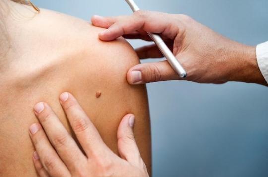 Melanoma: doctors denounce the examination of moles in pharmacies