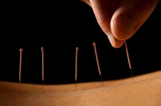 Alternative medicine: acupuncture to relieve symptoms of menopause 