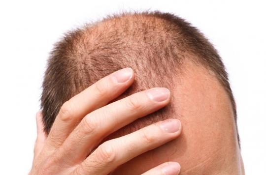 Baldness: the ANSM warns against the side effects of finasteride 