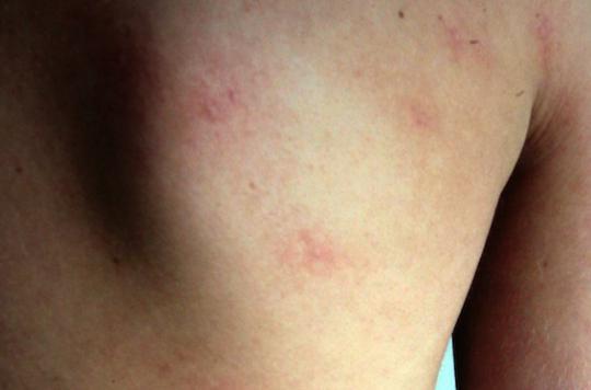 Urticaria: one in five people is affected 