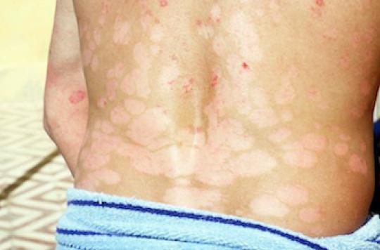 Psoriasis: the 5 misconceptions to fight