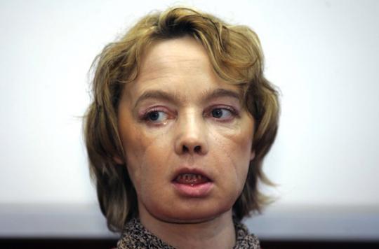 Isabelle Dinoire: death of the first face transplant recipient