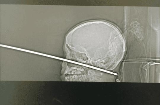 Baby boy miraculously survives after impaling his skull on a meat skewer