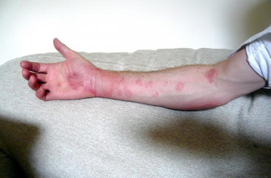 Urticaria: the difficult daily life of patients