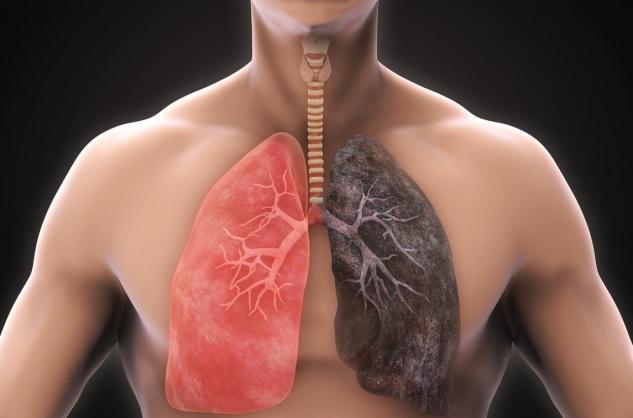 Santé - Cancer du poumon : la lutte passe par le dépistage